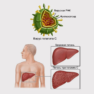 Что нужно знать о вирусном гепатите С?